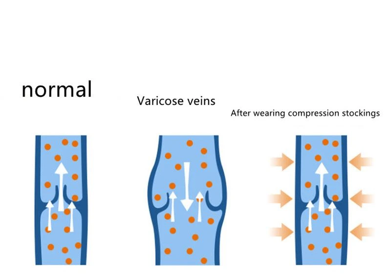 Medium Graduated 15-20 mmHgcompression socks medical price